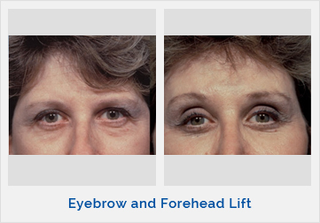 Eyebrow and Forehead Lift