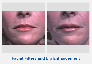 Facial Fillers and Lip Enhancement