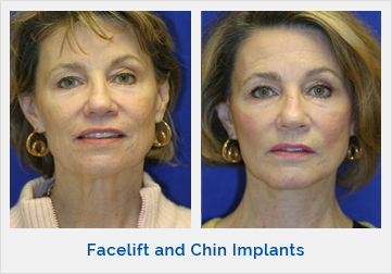 Facelift and Chin Implants