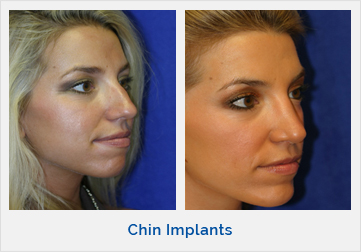 Chin Implants