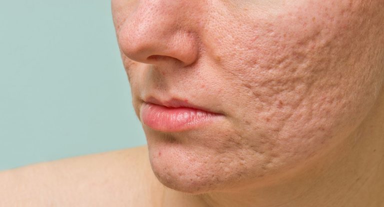 botox for acne scars | doctorbinder.com